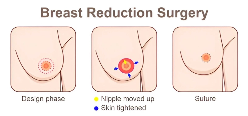 Post-Breast Reduction Care: What to Expect During Recovery