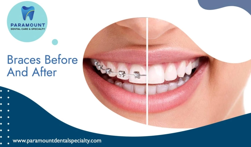 An Insight Into Braces Before And After