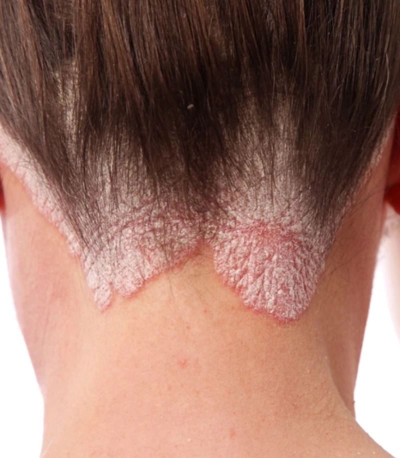 What are the Causes of Psoriasis: Detailed Insights