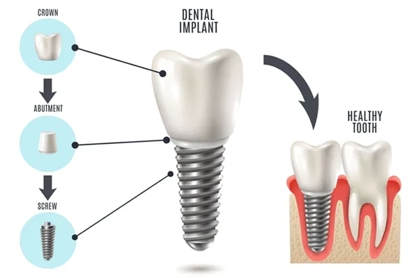 Dental Implant Treatment: Cost, Process, and Long-Term Benefits