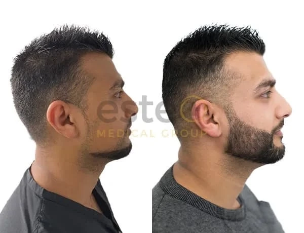 How Beard Transplants Create Natural Density