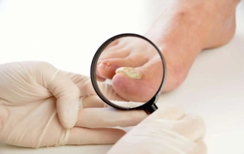 What Causes Thick Toenails and How to Treat Them