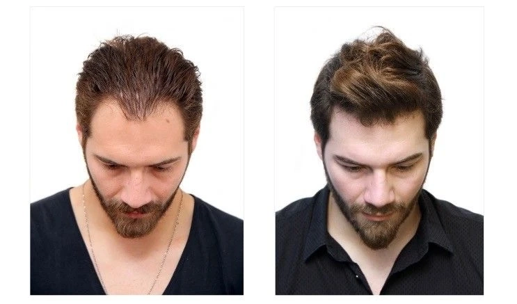 How To Find The Best Hair Transplant Clinic in Mysore?