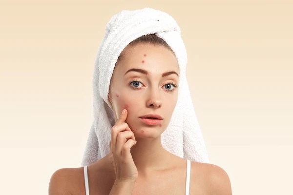 Acne Scar Treatment in Kolkata by Dr. Oindrila Dutta
