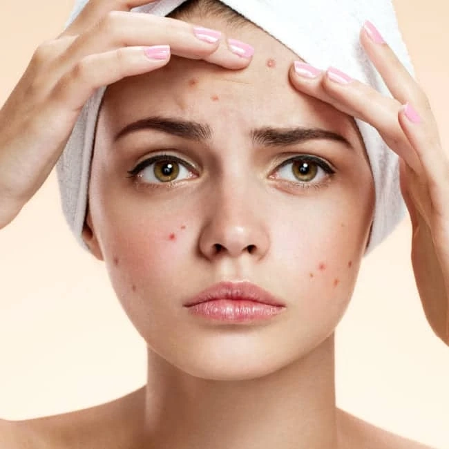 Acne and Mental Health: The Link Between Stress, Anxiety, and Breakouts