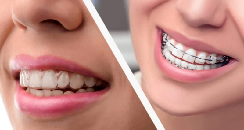 Affordable Dental Braces Houston, Texas