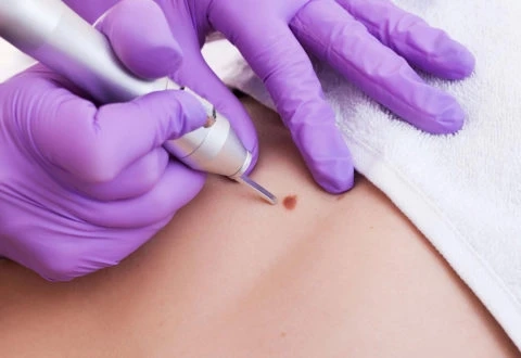 The Lowdown on Non-Surgical Options for Skin Tag Removal