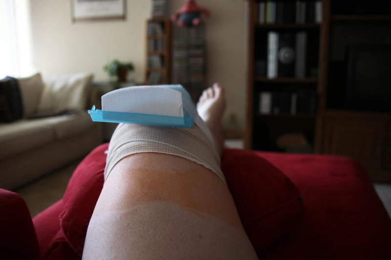 Post Knee Replacement Surgery: Preventive Measures For Quicker Recovery