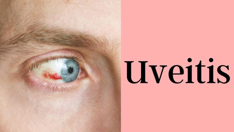 Uveitis Treatment
