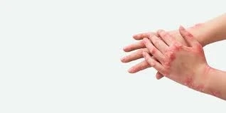 Psoriasis: Uncovering the Roots and Finding Lasting Relief with Functional Medicine