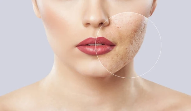 Pore Prowess: Riyadh's Expert Solutions for Flawless Skin