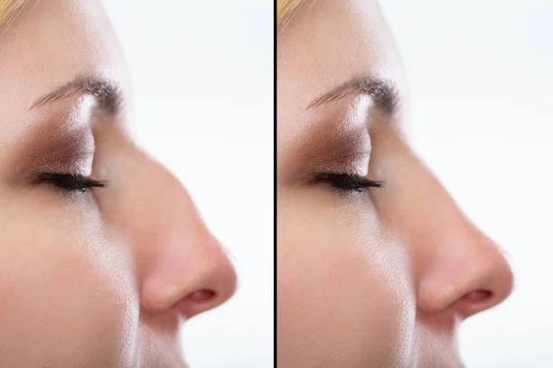 What is the Cost of Nose Job in India?