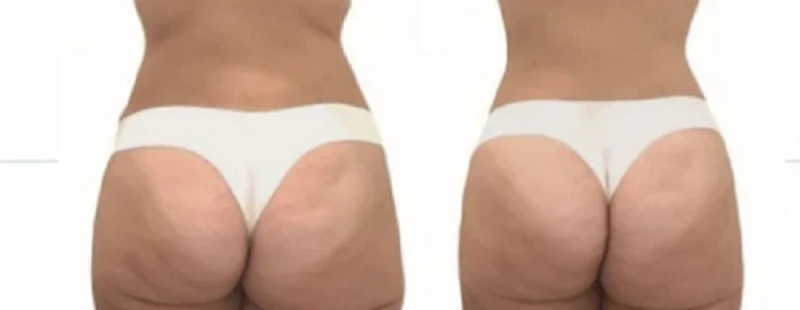 ¿Cuáles son los mejores lugares para recibir masajes reductores a precios asequibles en Madrid?