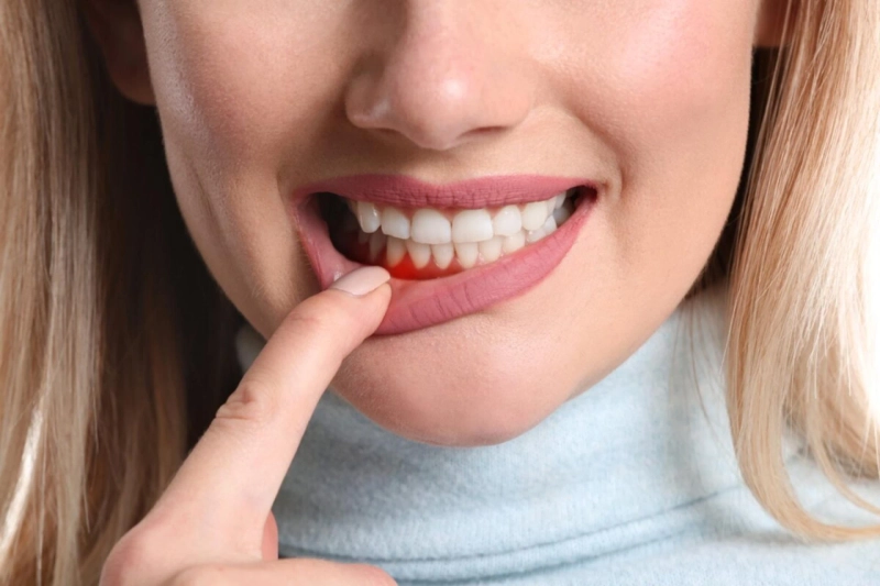 Top Causes of Swollen Gums While Wearing Braces