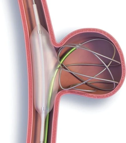 Interventional Intracranial Aneurysm Devices Are Advancing With Technological Advances