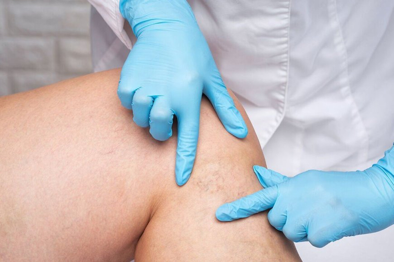 Silver Nitrate Skin Discoloration: Causes, Treatment, and Prevention Tips