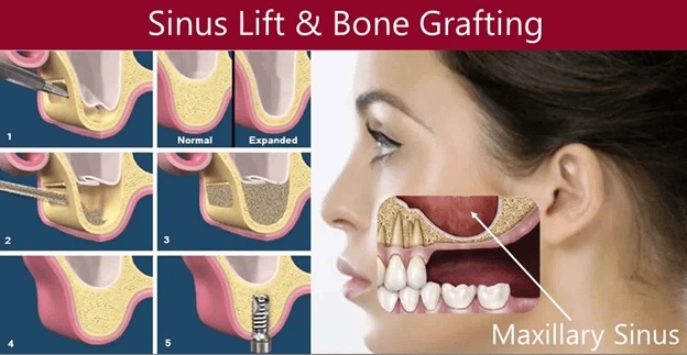 Sinus Lift Surgery: Restoring Dental Health and Ensuring Implant Success