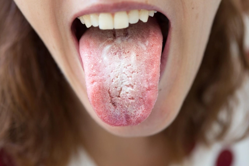 Candidiasis is one of the most common skin infection affects millions of people around the globe
