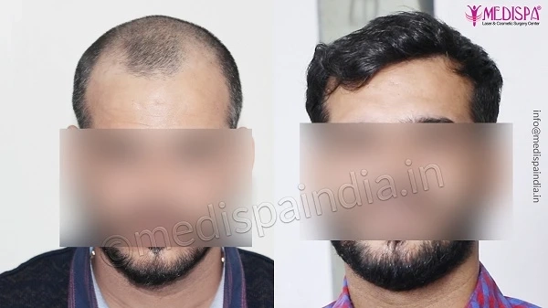 Can Hair Transplant Surgery Cure Hair Loss Issue Permanently?