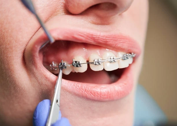 Achieving a Healthier Smile with Modern Orthodontic Care