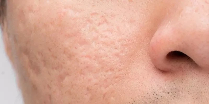 Achieve Clear Skin Goals: Acne Scar Treatments in Dubai
