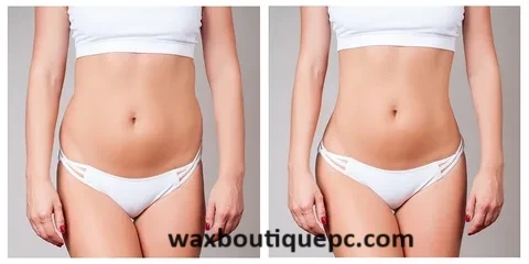 Choosing Non-Surgical Body Contouring for Long-Term Results