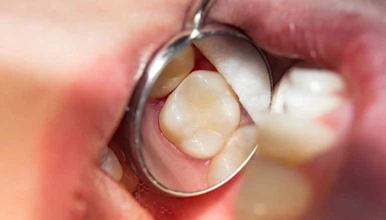 White Fillings in Kitchener | Benton Dental Clinic