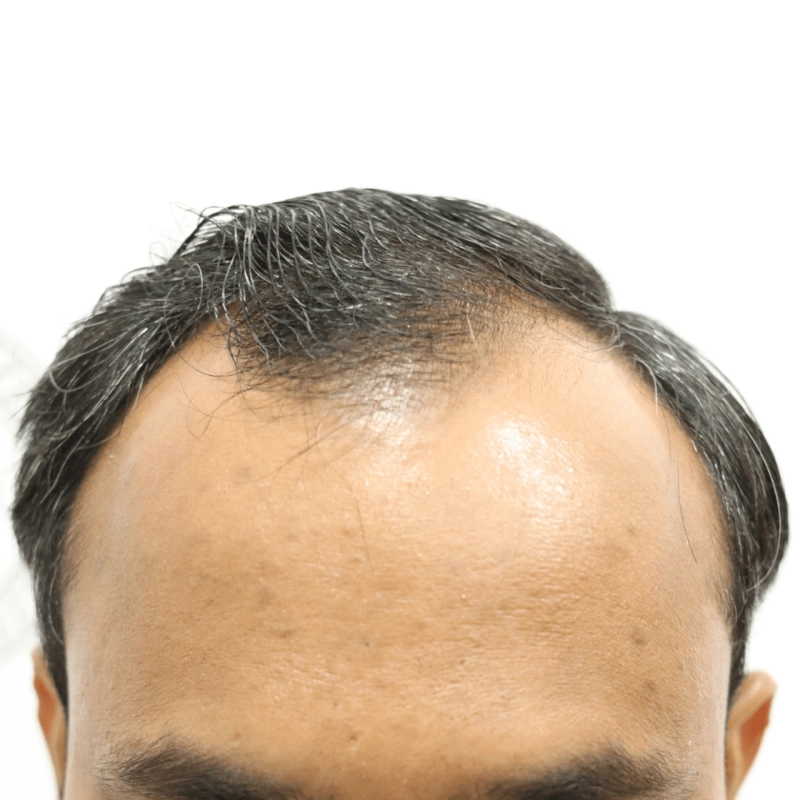 A Comprehensive Guide to Choosing the Right Hair Restoration Approach