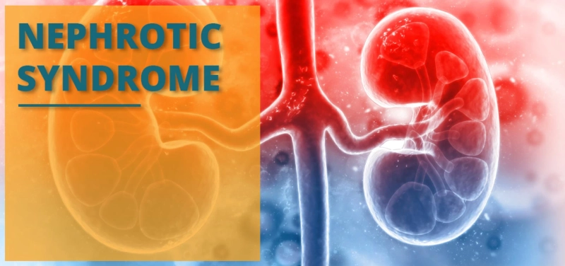 A Special Diet Tips For Nephrotic Syndrome Patients