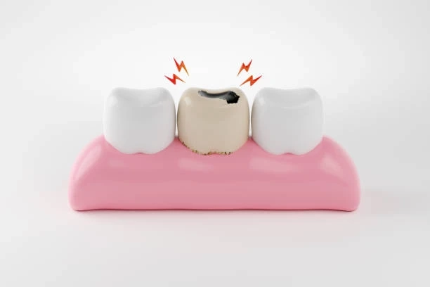 Professional Dental Filling Treatment for Healthy Smiles in Islamabad