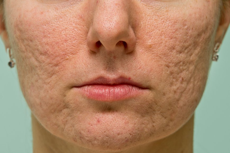 Preventing Acne Scars with the Expertise of Top Dermatologists