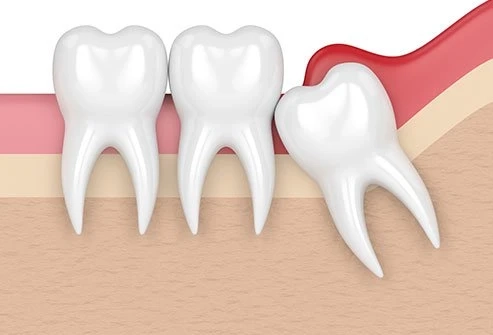 How to Close Up a Wisdom Tooth Hole