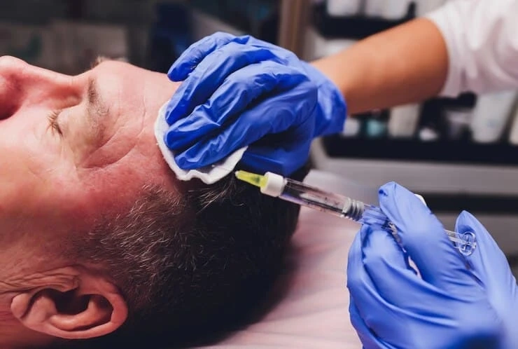 Why PRP is the Future of Hair Loss Treatment in Derby