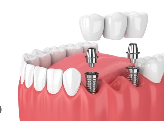 The Impact of Smoking on Dental Implant Healing and Longevity