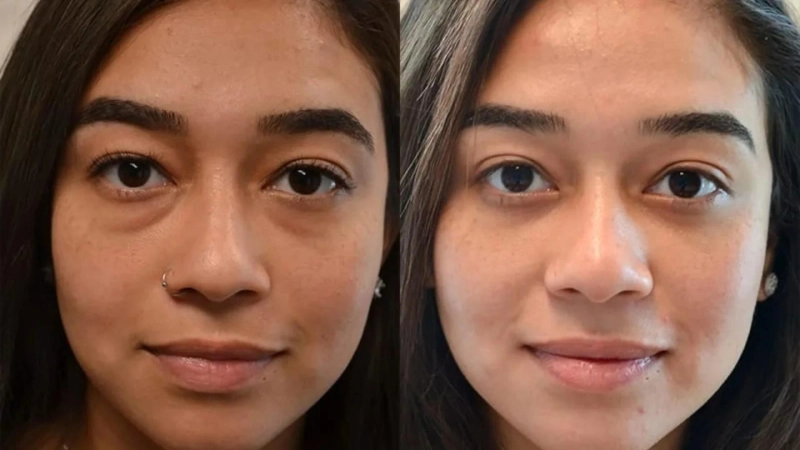 Expert Eyebrow Lift Cape Town: Blepharoplasty and Eyelid Surgery in South Africa