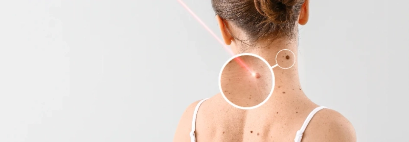 Skin numbing creams for skin tag removing surgery