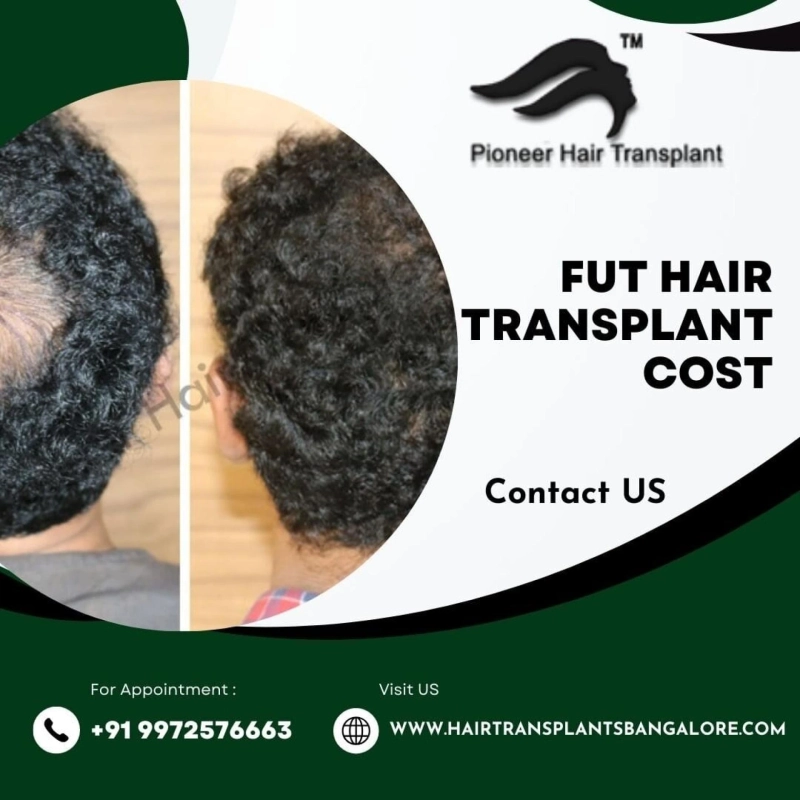 Tips for Saving on FUT Hair Transplant Cost