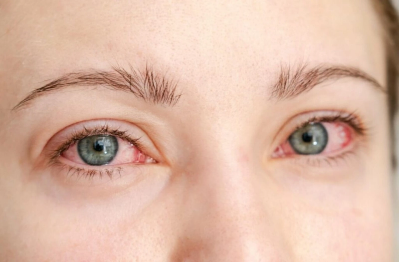 6 Common Causes of Dry Eyes You Should Be Aware of