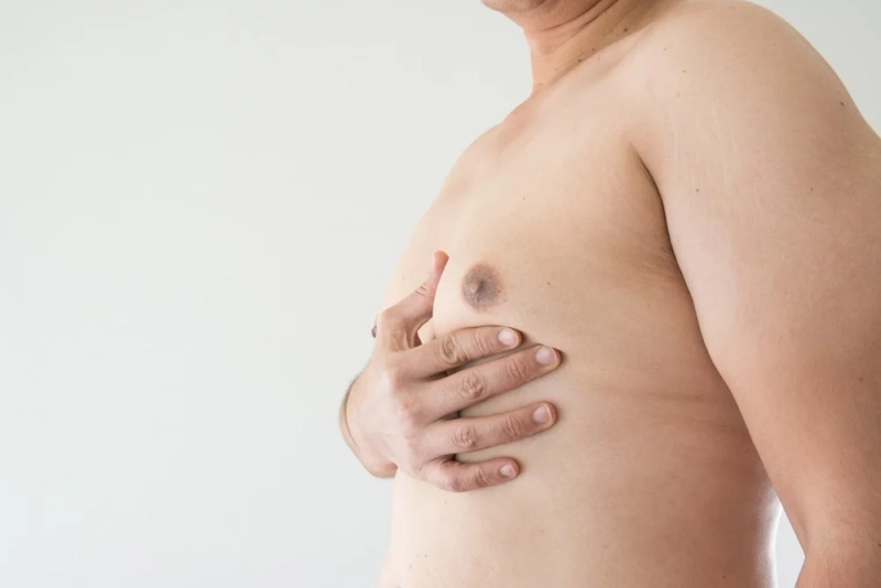  The Male Dilemma: Coping with Gynecomastia