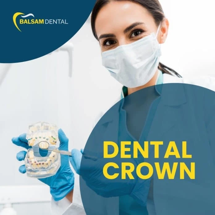 An Optimal Guide to Crowns in Toronto used for Dental Health