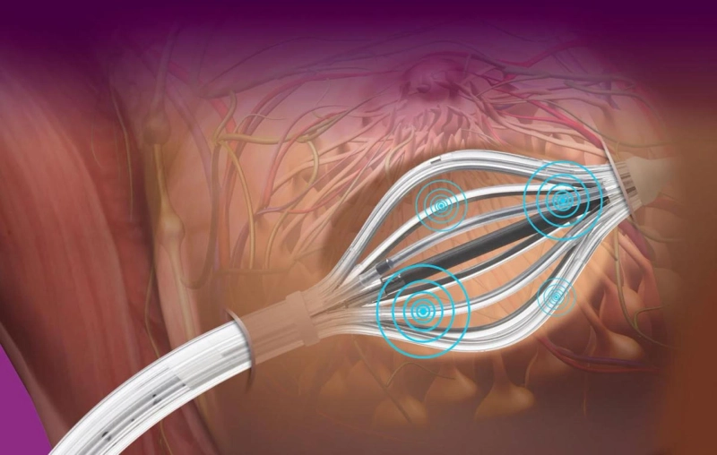 Promising Trends And Technologies And Future Of Brachytherapy