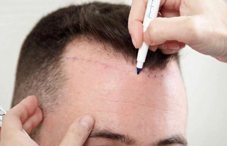 Discover the Benefits of Hair Transplant in Islamabad