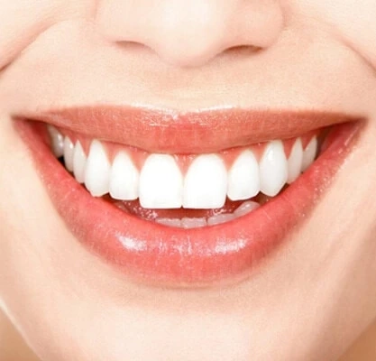 Radiant Smiles: Cascade Family Dental's Professional Dental Whitening Kits