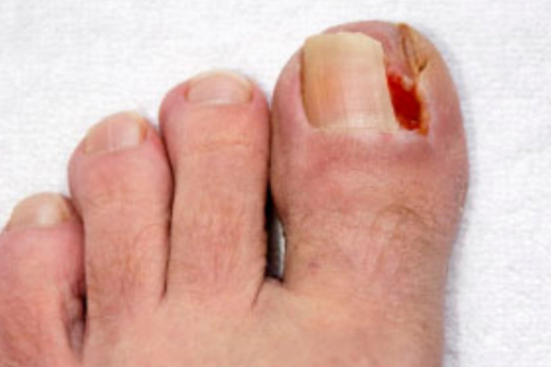 The Guide to Ingrown Toenail Removal: Tips, Treatments, and Aftercare