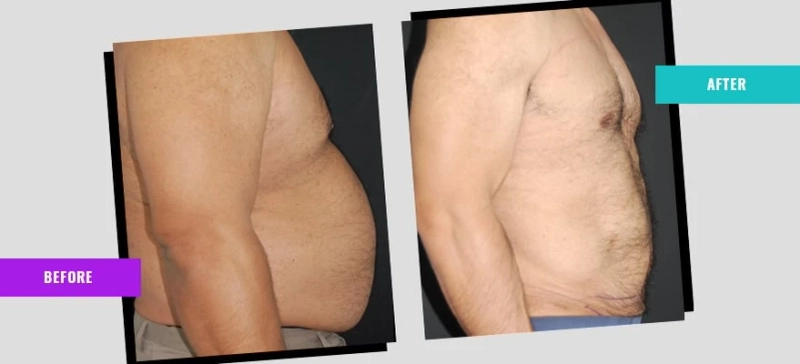The New Way to Remove Unwanted Fat