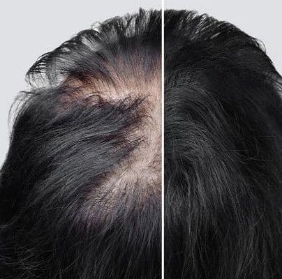 Duration of Results after Hair Restoration Surgery