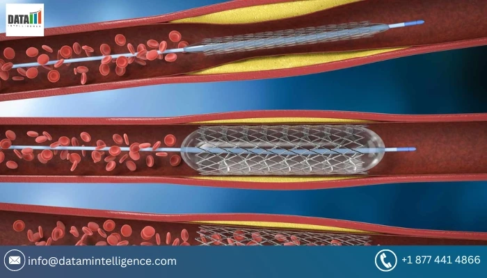 Global Angioplasty Balloons Market Size, Share, Industry Report, Growth, Price, Key Players and Forecast 2023-2030