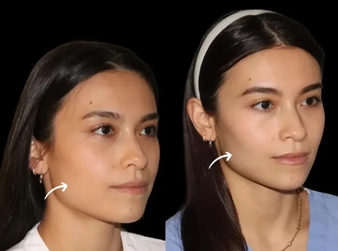 Book Your Sculptra Fillers Consultation with Dubai’s Best Aesthetic Clinics