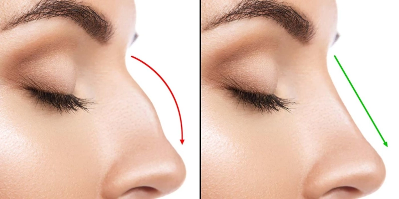What are the Benefits of Rhinoplasty