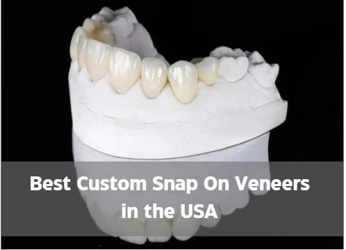 What to expect when you buy custom-made snap on veneers?